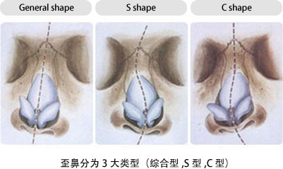 General shape, S shape, C shape 歪鼻分为3大类型（综合型,S型,C 型）