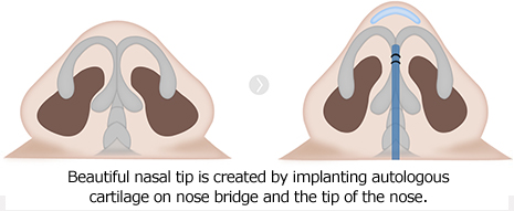 鼻柱和鼻尖自体软骨移植，做出漂亮的鼻尖