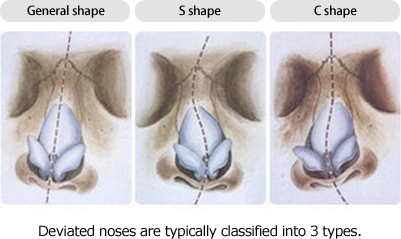 General shape, S shape, C shape Deviated noses are typically classified into 3 types.