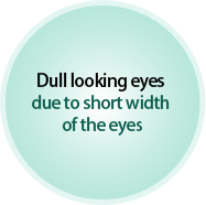 Dull looking eyes due to short width of the eyes