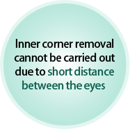 Inner corner removal cannot be carried out due to short distance between the eyes