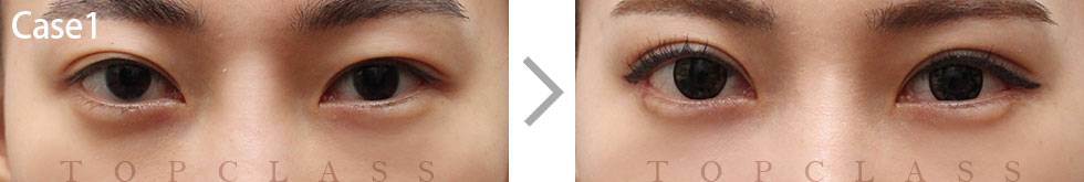 Case1 Revisional Double Eyelid Surgery Before/After
