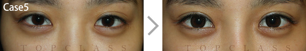 Case5 Natural Adhesion Double Eyelid Technique Before/After