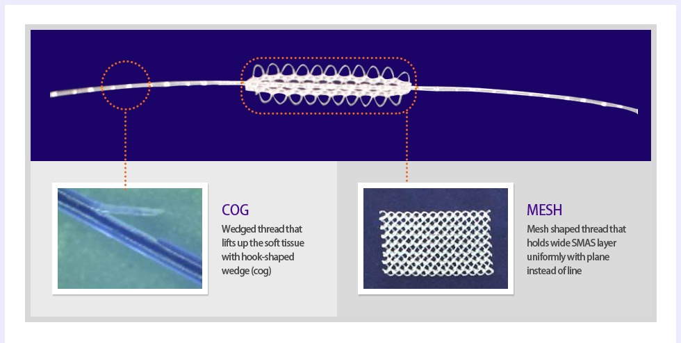 cog Wedged thread that lifts up the soft tissue with hook-shaped wedge (cog),mesh Mesh shaped thread that holds wide SMAS layer uniformly with plane instead of line